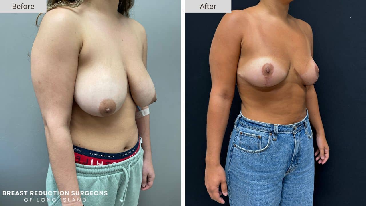 Breast Reduction Long Island Before & After Patient 125b
