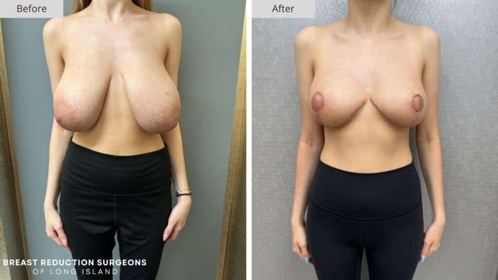 Breast Reduction Long Island Before & After Patient 126a