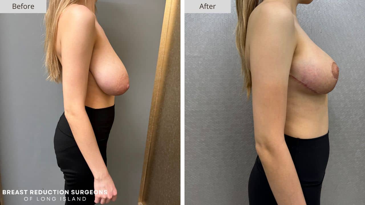 Breast Reduction Long Island Before & After Patient 126c