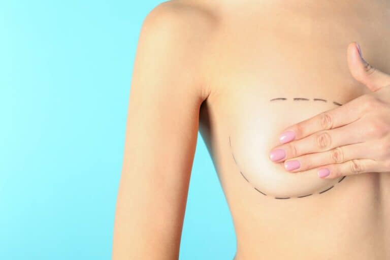 woman with marks on her breast for reduction