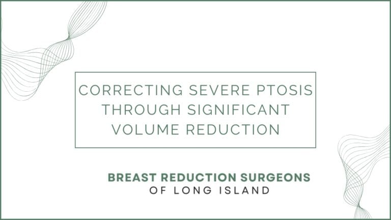 Case Study: Correcting Severe Ptosis Through Significant Volume Reduction